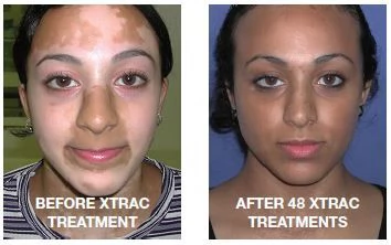 Get Rid Of Vitiligo In Somerville City in Massachusetts Tattoo Removal Oil In USA Call 27710732372 | Foto 3