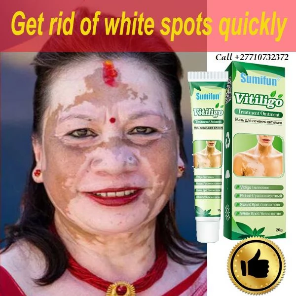 Get Rid Of Vitiligo In Somerville City in Massachusetts Tattoo Removal Oil In USA Call 27710732372